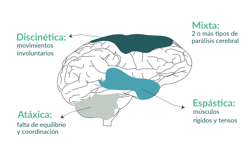 Imagen ilustrativa de los 4 tipos de Parálisis Cerebral