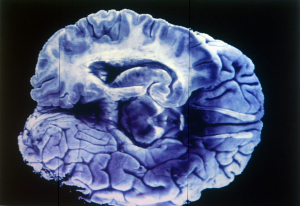 Alzheimer cerebro